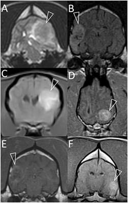 Frontiers | Glioma Mimics: Magnetic Resonance Imaging Characteristics